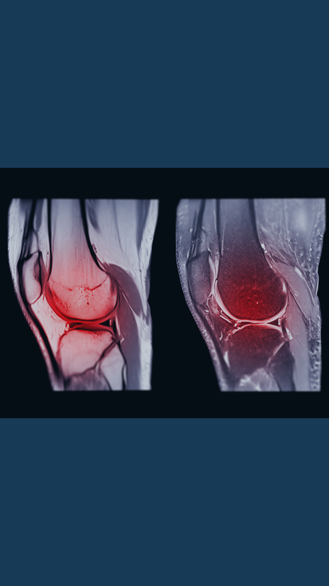 Advancements in Physiotherapy Management of ACL Tears: A Brief Summary of Latest Research and Implementation