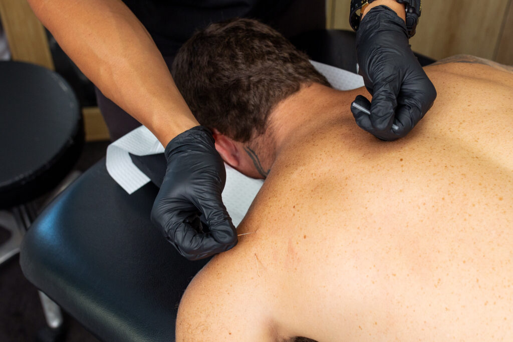 Dry Needling