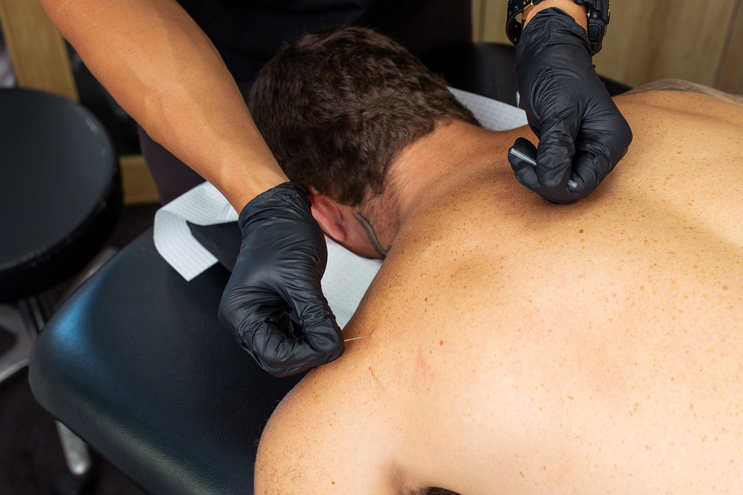 Dry Needling